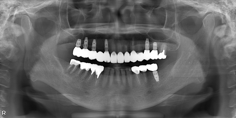 治療後のレントゲン写真