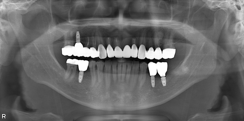 治療後のレントゲン写真