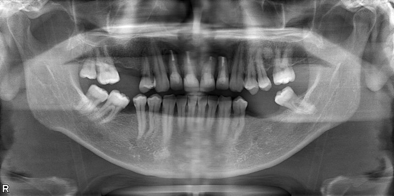 治療前のレントゲン写真