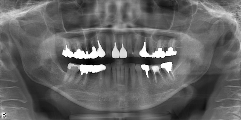 治療後のレントゲン写真