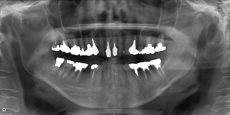 治療前のレントゲン写真