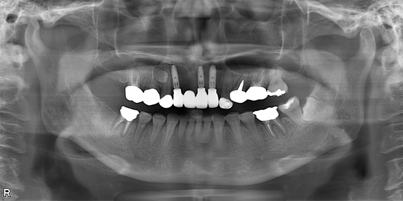 治療後のレントゲン写真