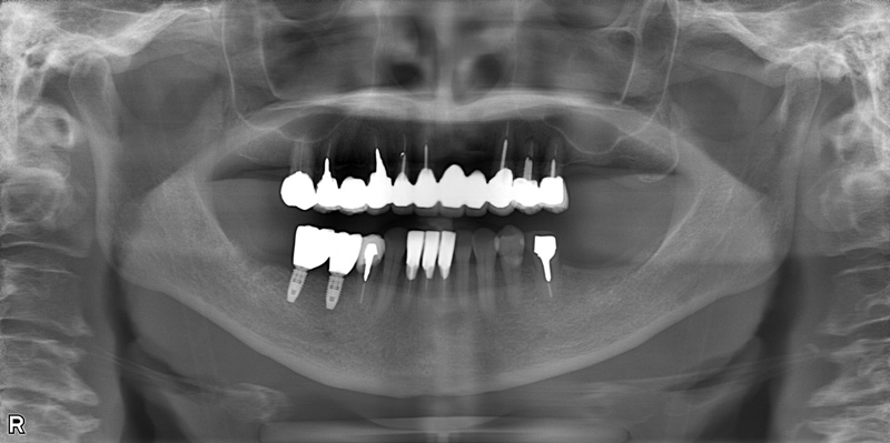 治療後のレントゲン写真