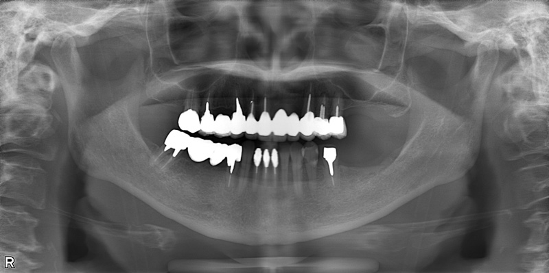 治療前のレントゲン写真
