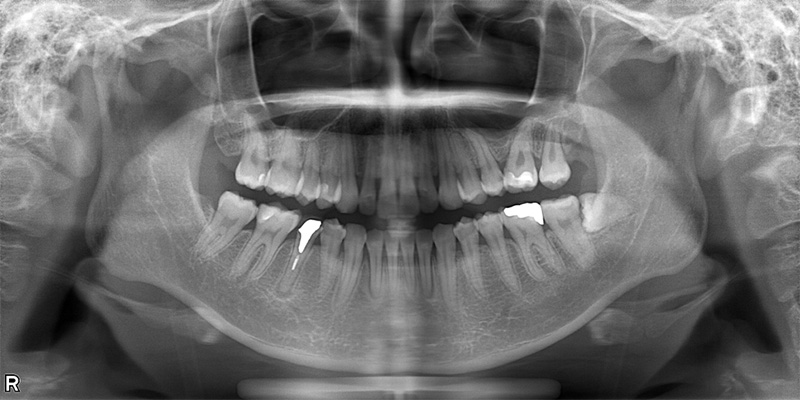 治療後のレントゲン写真