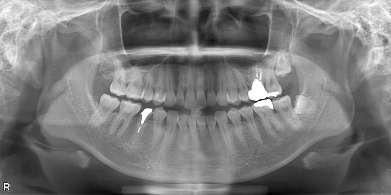 治療前のレントゲン写真