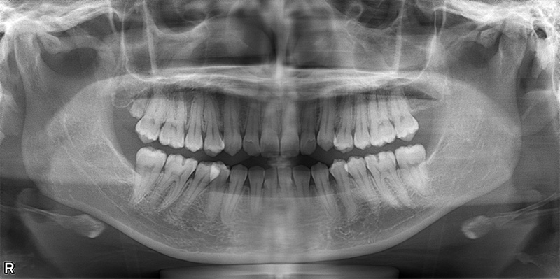 治療前のレントゲン写真