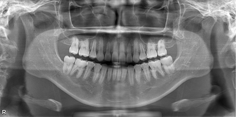 治療後のレントゲン写真