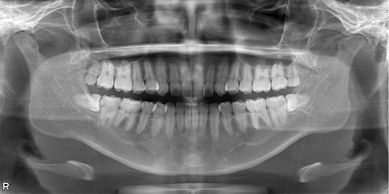 治療前のレントゲン写真