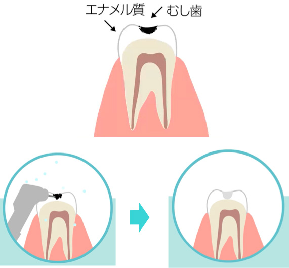 初期のむし歯の治療イメージ