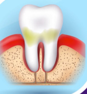 初期の歯周炎
