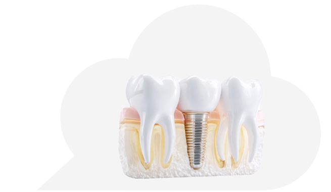 インプラント治療について