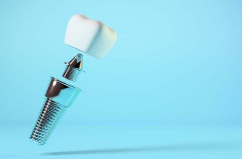 インプラントの構造図