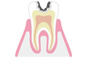中等度のむし歯の治療イメージ