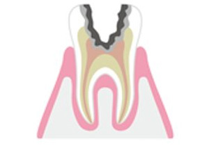 神経に達しているむし歯の治療イメージ