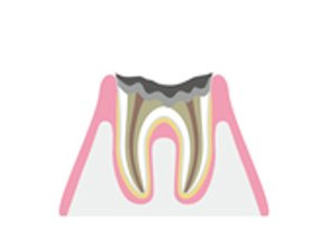 歯の根の部分にまで進行しているむし歯の治療イメージ